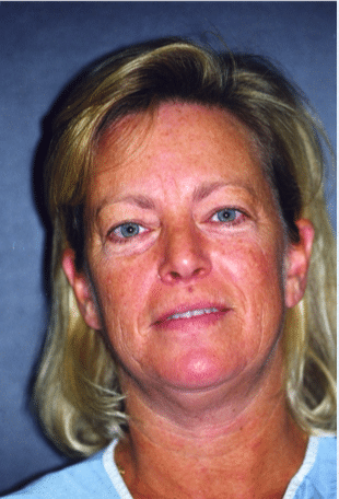 Before Image: Neck Liposuction, Platysmaplasty, Chin Implant - front