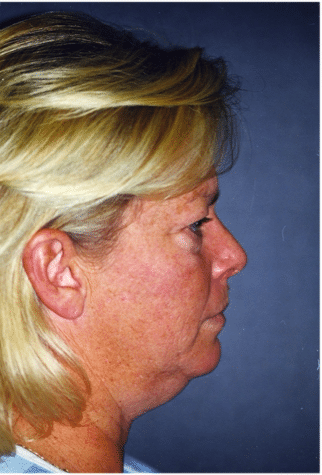 Before Image: Neck Liposuction, Platysmaplasty, Chin Implant - right-side