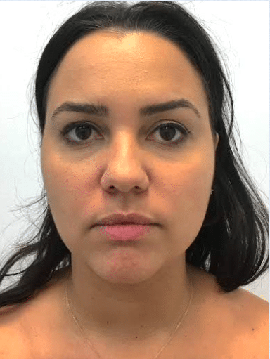 After Image: Neck Liposuction, Platysmaplasty, Chin Implant - front