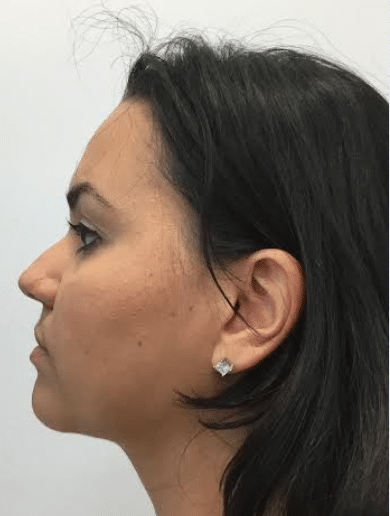After Image: Neck Liposuction, Platysmaplasty, Chin Implant - left-side