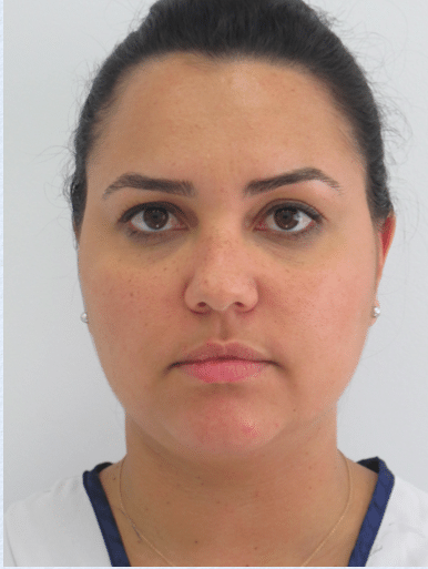 Before Image: Neck Liposuction, Platysmaplasty, Chin Implant - front