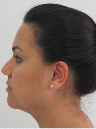 Before Image: Neck Liposuction, Platysmaplasty, Chin Implant - left-side