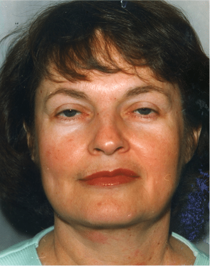 After Image: Neck Liposuction, Platysmaplasty, Chin Implant - front