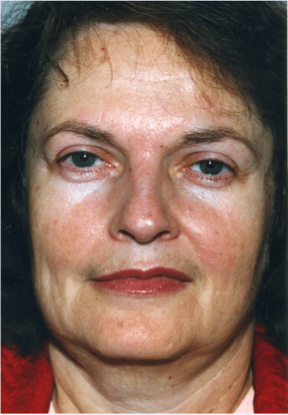Before Image: Neck Liposuction, Platysmaplasty, Chin Implant - front