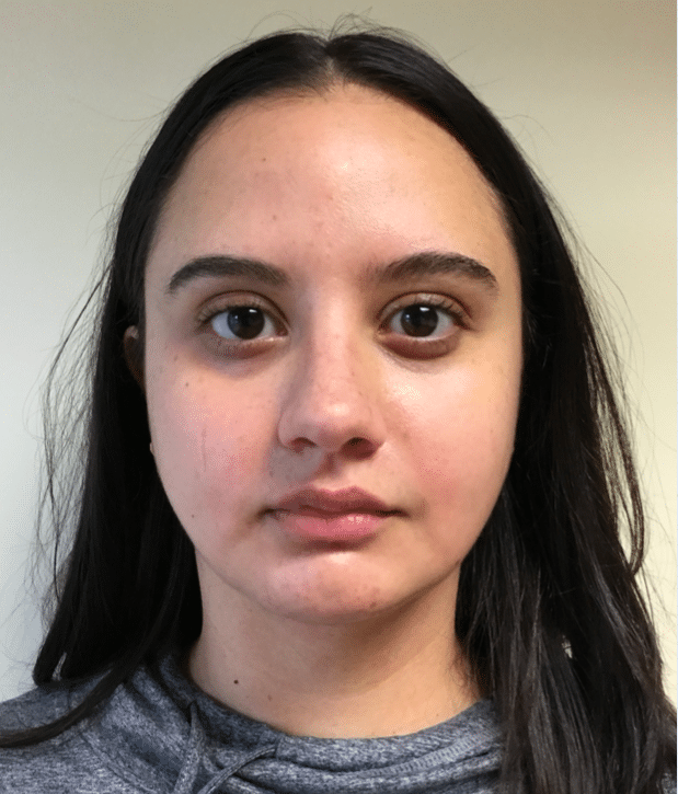 After Image: Neck Liposuction, Platysmaplasty, Chin Implant - front
