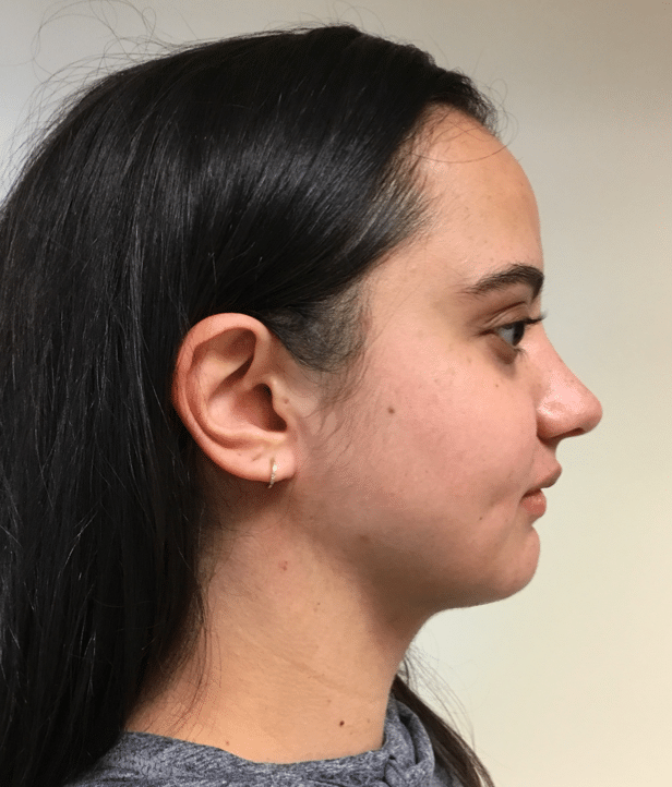 After Image: Neck Liposuction, Platysmaplasty, Chin Implant - right-side