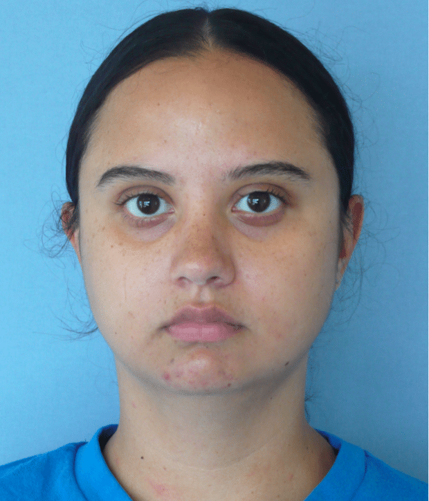 Before Image: Neck Liposuction, Platysmaplasty, Chin Implant - front