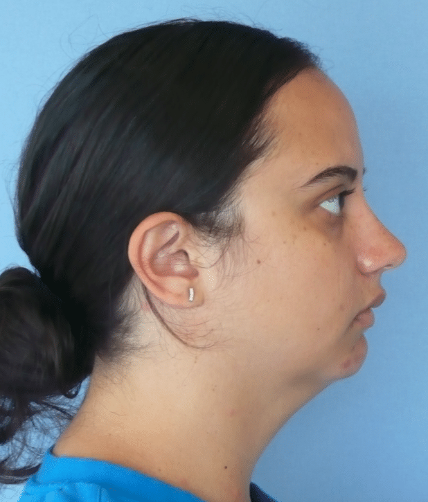 Before Image: Neck Liposuction, Platysmaplasty, Chin Implant - right-side