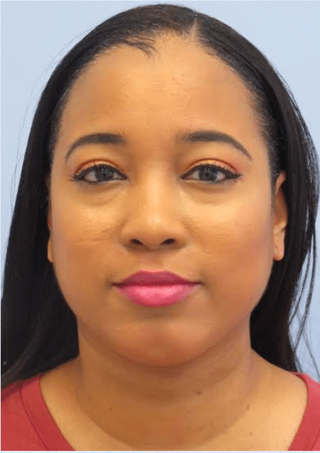 After Image: Neck Liposuction, Platysmaplasty, Chin Implant - front