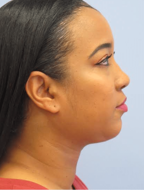 After Image: Neck Liposuction, Platysmaplasty, Chin Implant - right-side