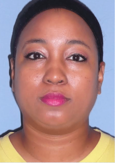 Before Image: Neck Liposuction, Platysmaplasty, Chin Implant - front