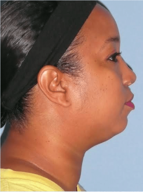 Before Image: Neck Liposuction, Platysmaplasty, Chin Implant - right-side