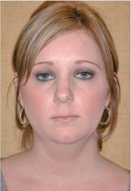 Before Image: Neck Liposuction, Platysmaplasty, Chin Implant - front
