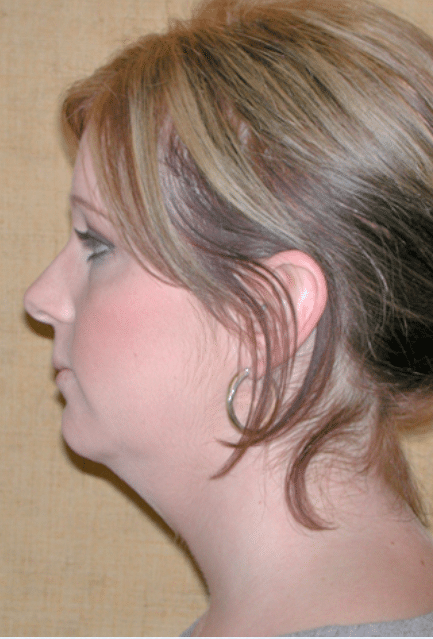 Before Image: Neck Liposuction, Platysmaplasty, Chin Implant - left-side