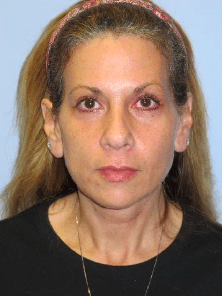 After Image: Neck Liposuction, Platysmaplasty, Chin Implant - front