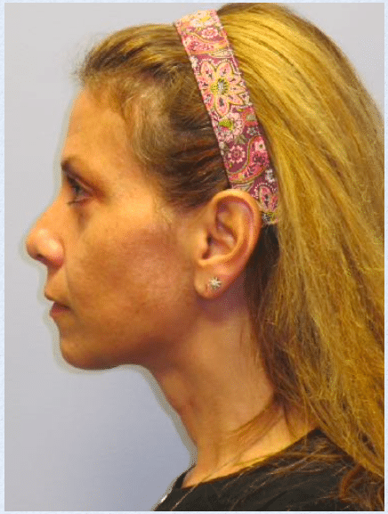 After Image: Neck Liposuction, Platysmaplasty, Chin Implant - left-side