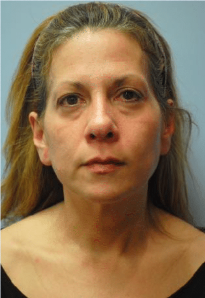 Before Image: Neck Liposuction, Platysmaplasty, Chin Implant - front
