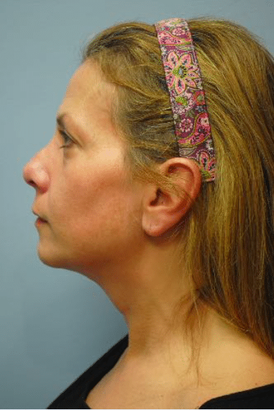 Before Image: Neck Liposuction, Platysmaplasty, Chin Implant - left-side