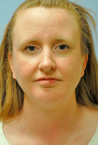 After Image: Neck Liposuction, Platysmaplasty, Chin Implant - front