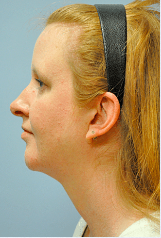 After Image: Neck Liposuction, Platysmaplasty, Chin Implant - left-side