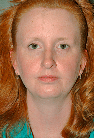 Before Image: Neck Liposuction, Platysmaplasty, Chin Implant - front
