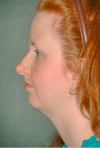 Before Image: Neck Liposuction, Platysmaplasty, Chin Implant - left-side