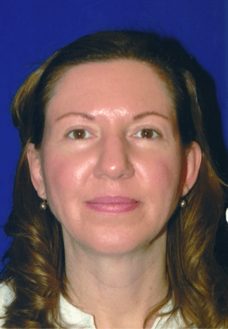 After Image: Neck Liposuction, Platysmaplasty, Chin Implant - front