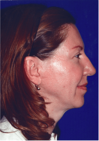 After Image: Neck Liposuction, Platysmaplasty, Chin Implant - right-side