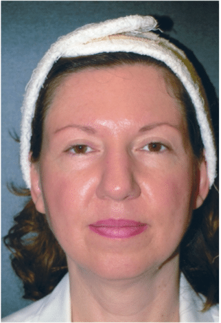 Before Image: Neck Liposuction, Platysmaplasty, Chin Implant - front
