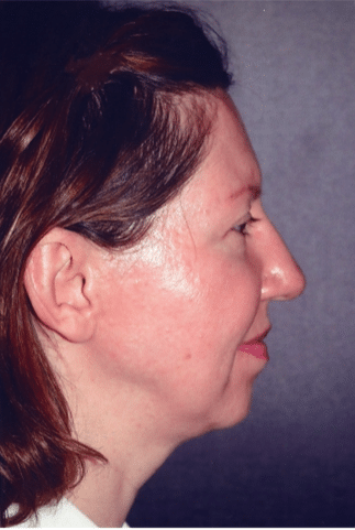 Before Image: Neck Liposuction, Platysmaplasty, Chin Implant - right-side