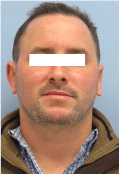 After Image: Otoplasty - front