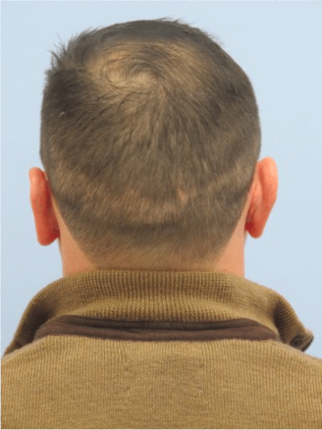 After Image: Otoplasty - back