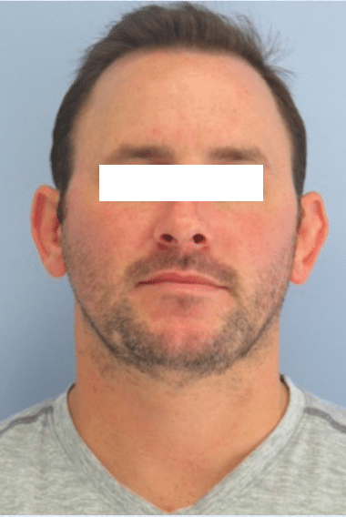 Before Image: Otoplasty - front