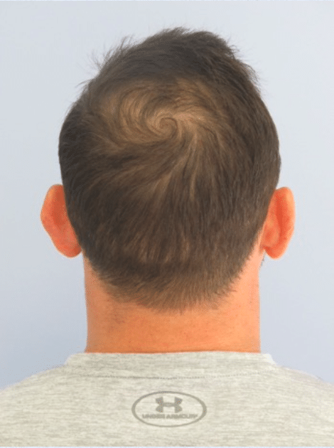 Before Image: Otoplasty - back