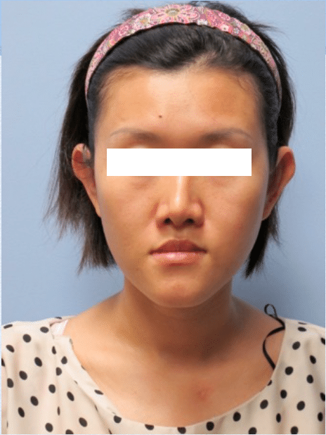 After Image: Otoplasty - front