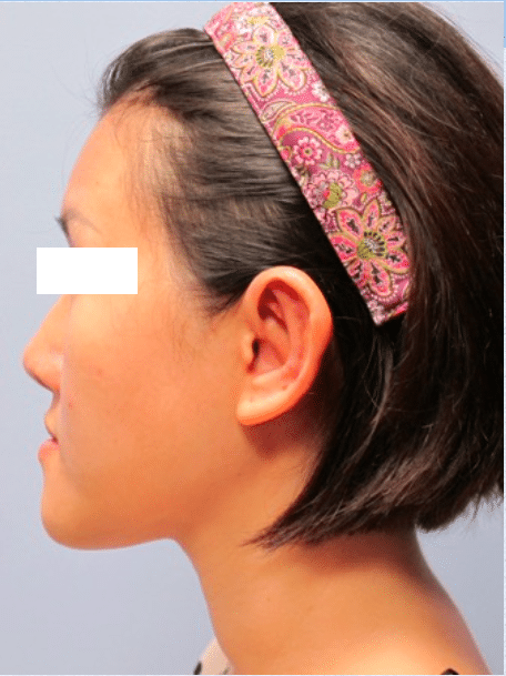 After Image: Otoplasty - left-side