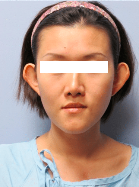 Before Image: Otoplasty - front