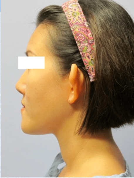 Before Image: Otoplasty - left-side