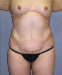 After Image: Tummy Tuck - front
