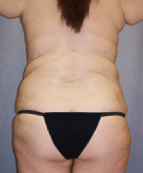 After Image: Tummy Tuck - back