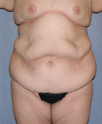 Before Image: Tummy Tuck - front