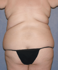 Before Image: Tummy Tuck - back