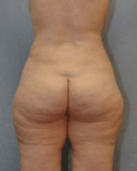 After Image: Tummy Tuck - back