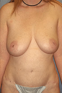 After Image: Tummy Tuck - front