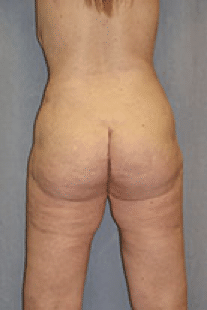 After Image: Tummy Tuck - back