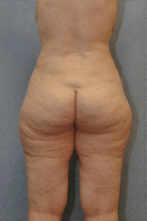 Before Image: Tummy Tuck - back