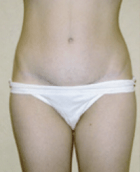 After Image: Tummy Tuck - front