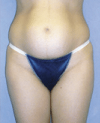 Before Image: Tummy Tuck - front