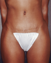 After Image: Tummy Tuck - front