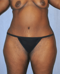 After Image: Tummy Tuck - front